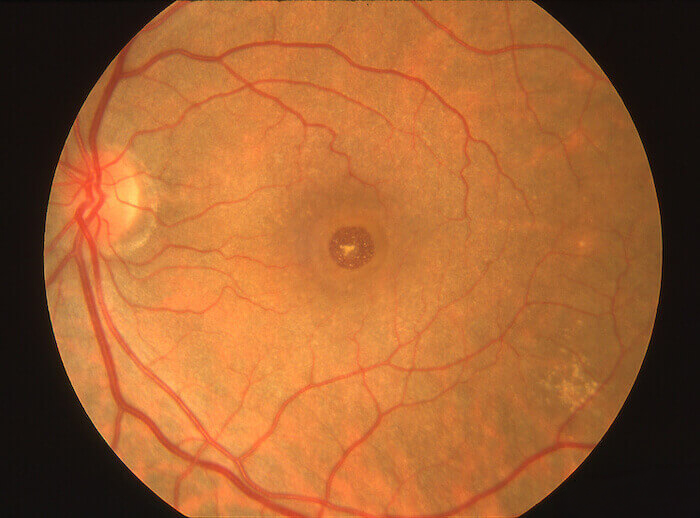 Retina photograph showing a macular hole