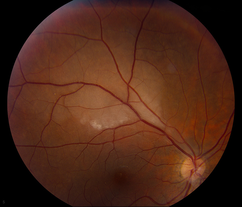 Retina photograph showing a branch retinal artery occlusion with pale, whitened retina