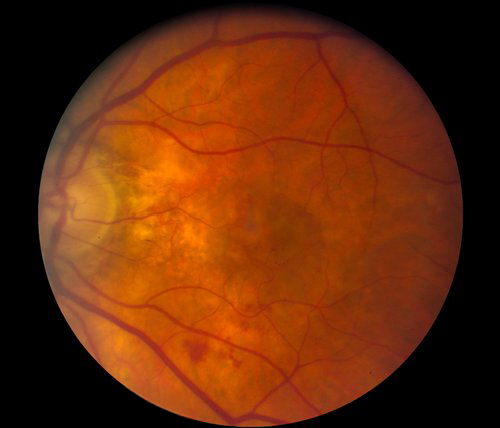 Retina photograph showing a choroidal neovascular membrane from wet macular degeneration