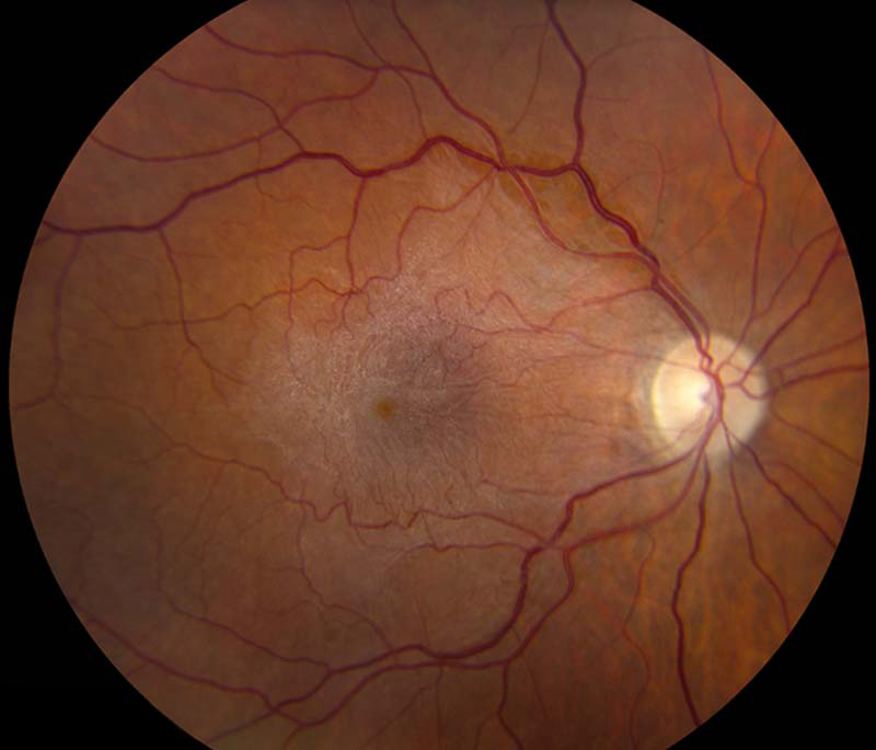 Retina photograph showing the glistening sheen of an epiretinal membrane over the macula