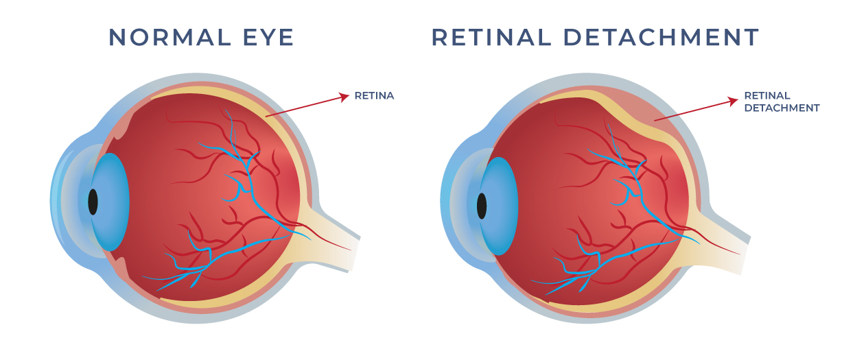 Diagram comparing a normal eye to an eye with a retinal detachment