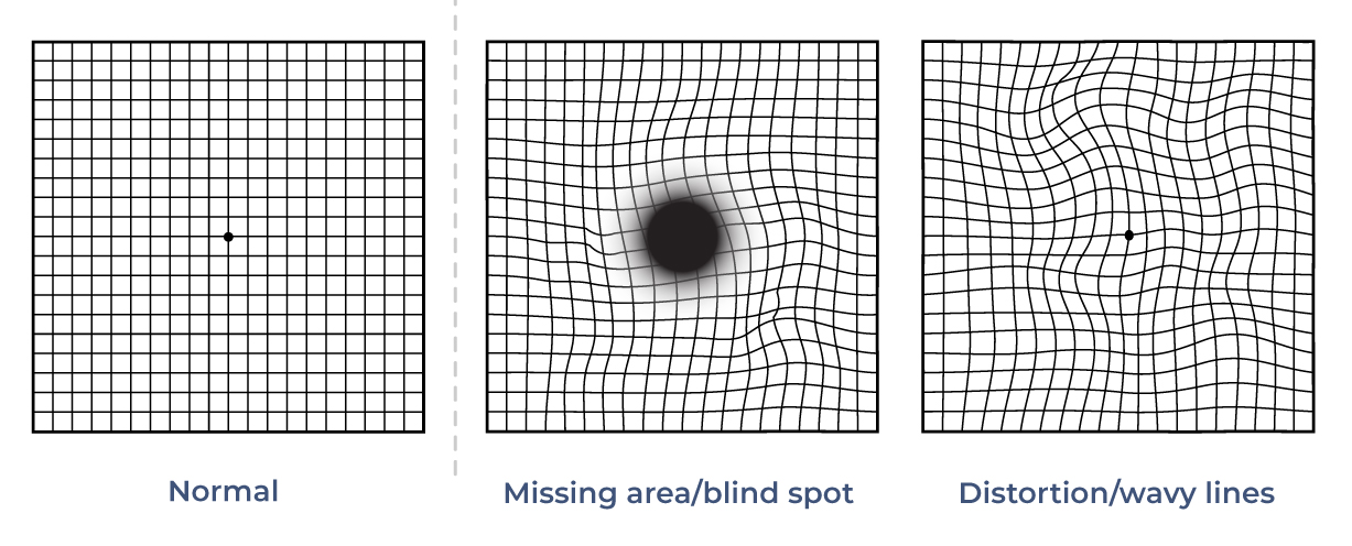 Amsler grid examples: normal, missing area or blind spot, and distortion with wavy lines