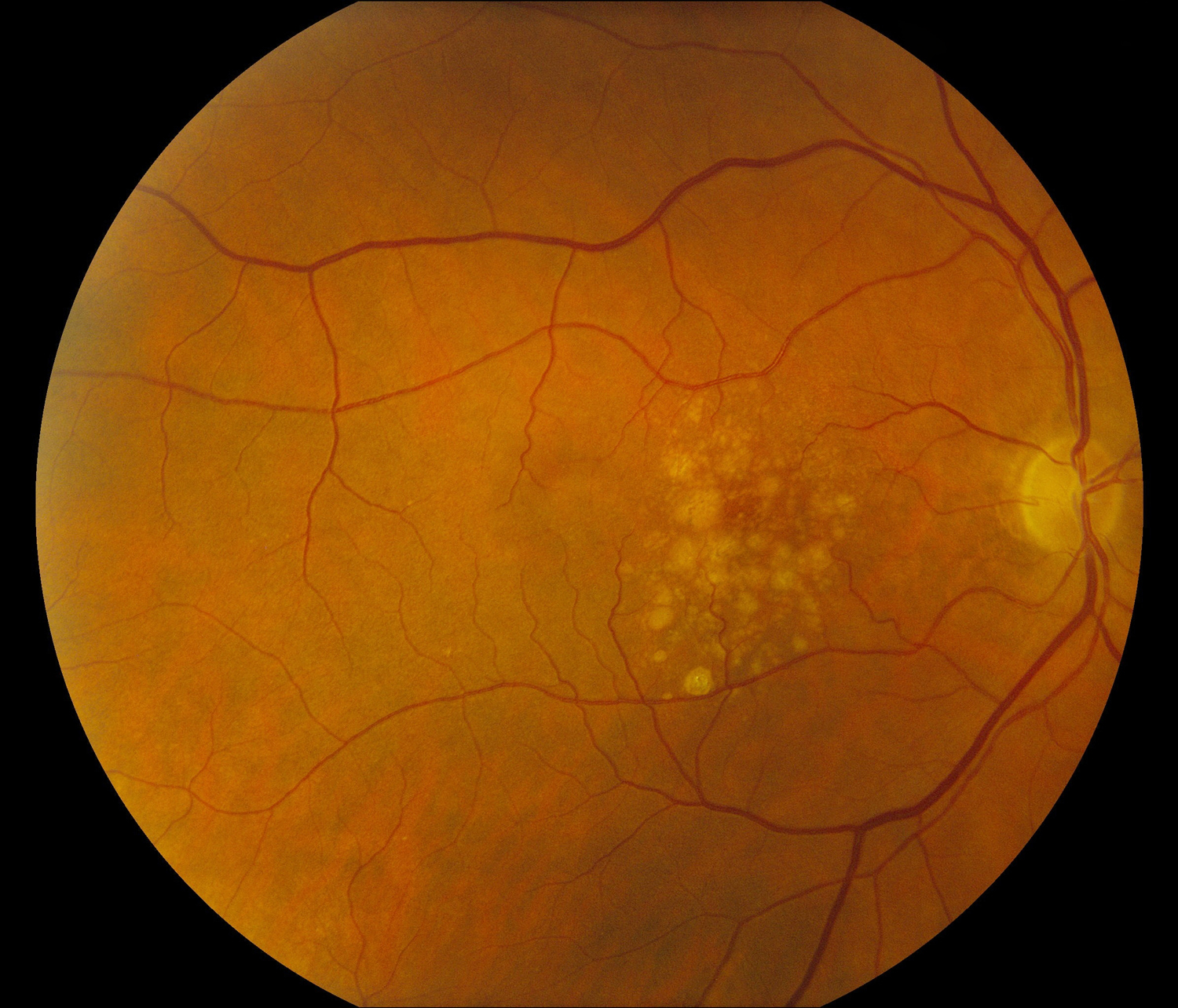 Retina photograph showing drusen from macular degeneration