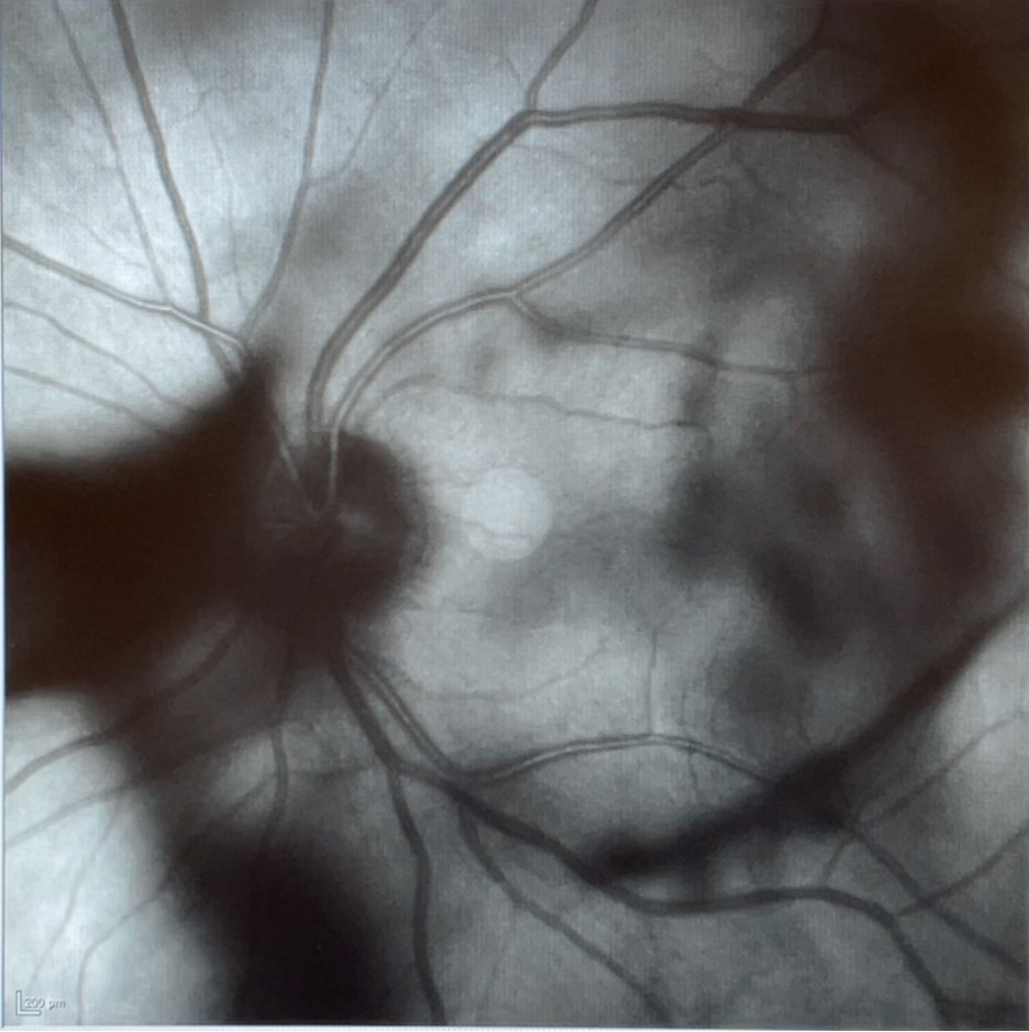 Red-free retina photograph showing vitreous floaters