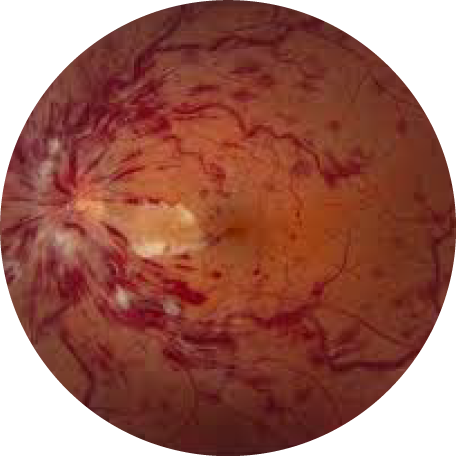 Retina photograph: Vein & Artery Occlusions