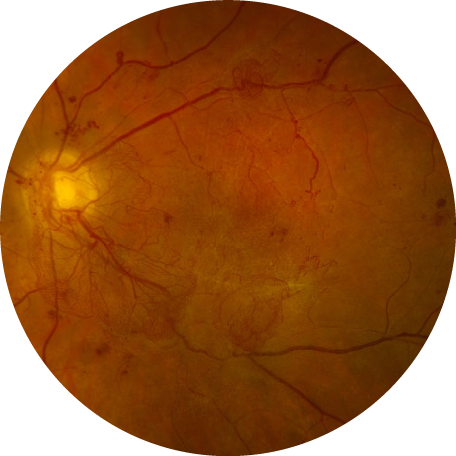Retina photograph: Diabetic Retinopathy