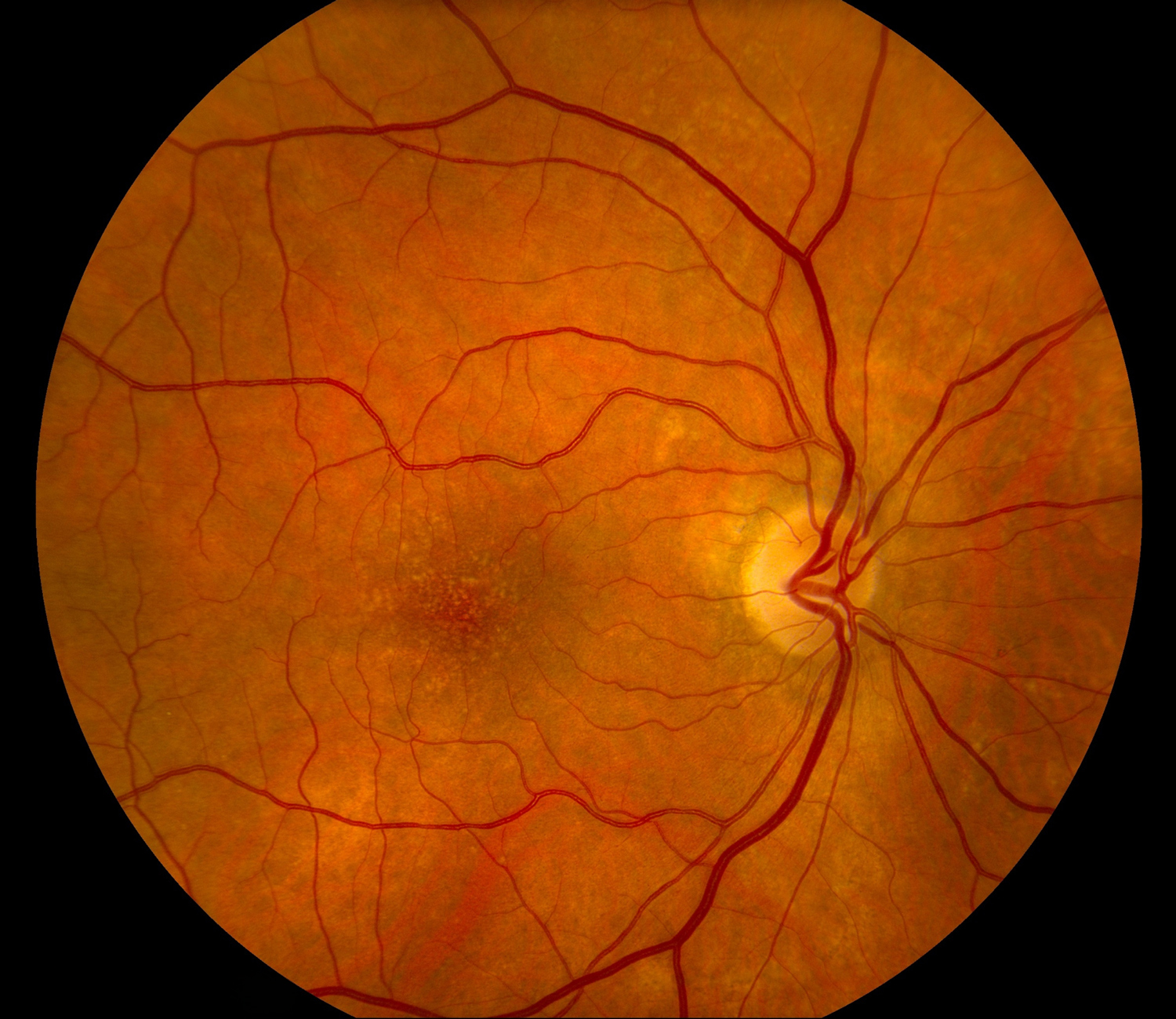 Retina photograph showing early macular degeneration with scattered small drusen