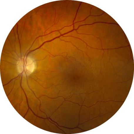 Retina photograph: Epiretinal Membrane