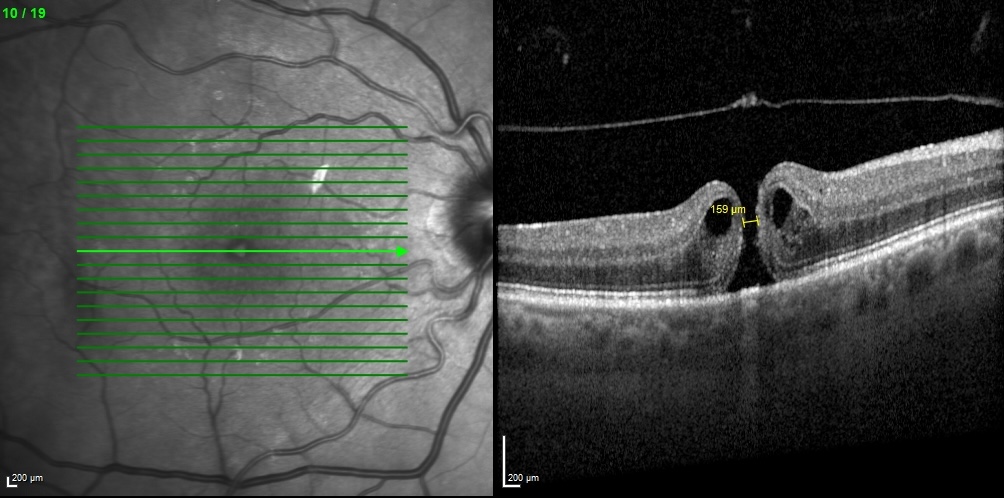 OCT scan showing a full-thickness macular hole in cross-section with cystic edges