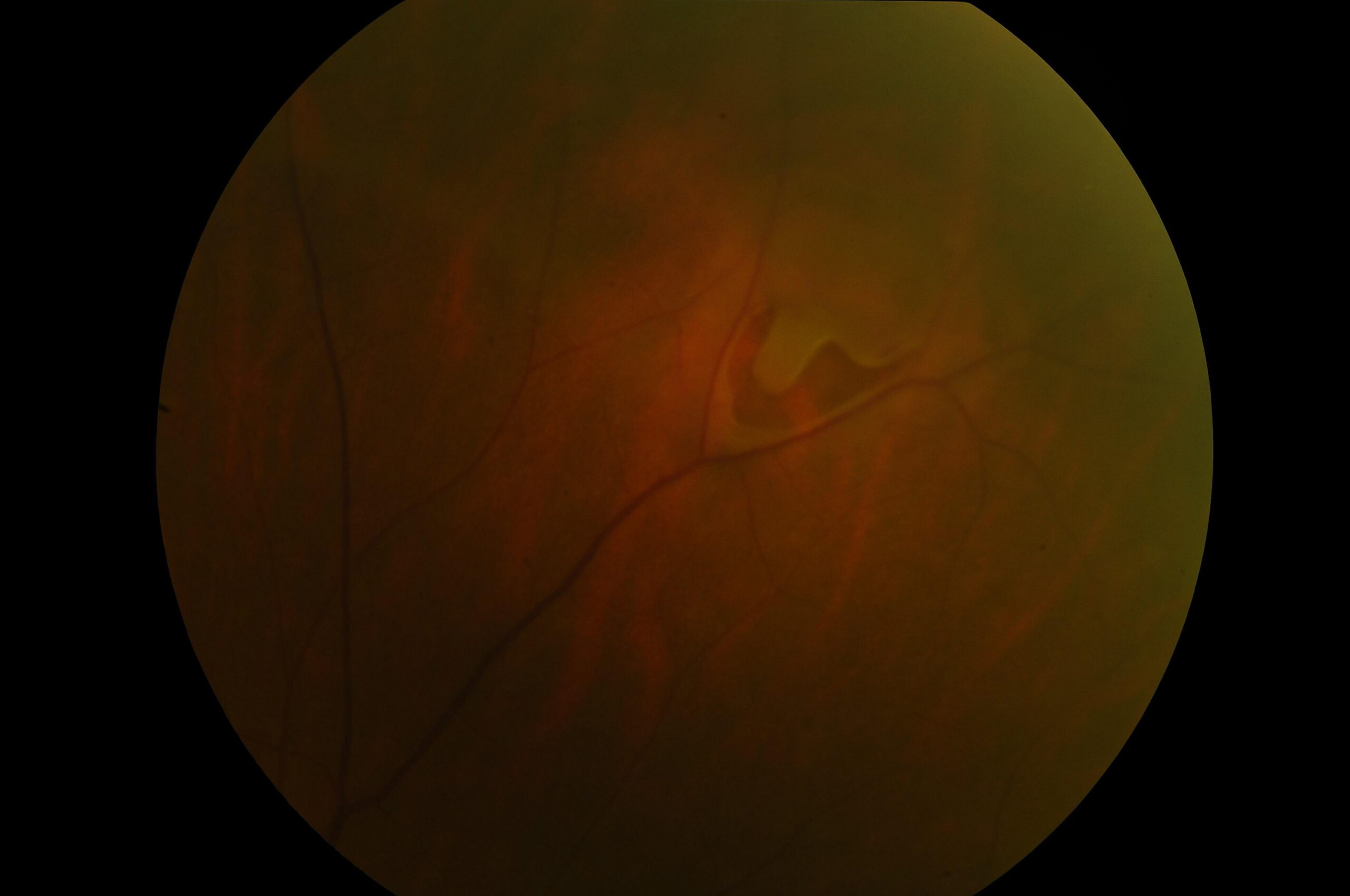 Retina photograph showing a retinal tear