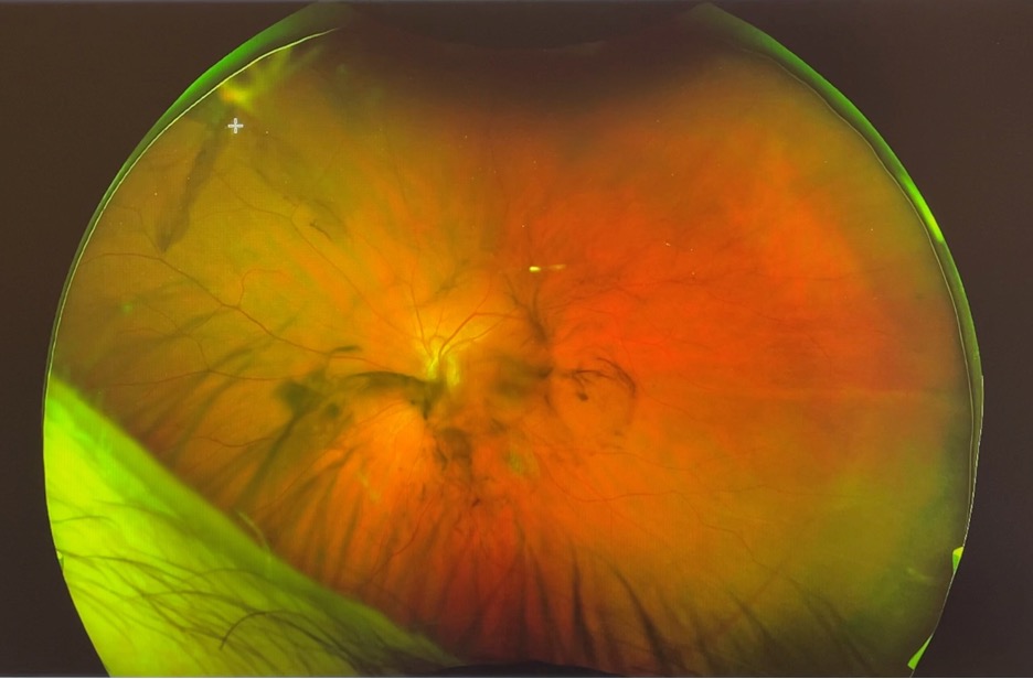 Widefield retina photograph showing a horseshoe retinal tear with vitreous hemorrhage