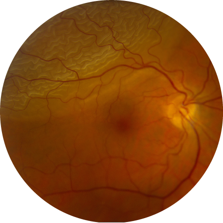 Retina photograph: Retinal Detachment
