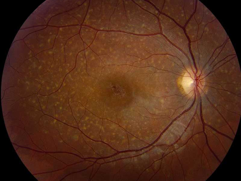 Retina photograph showing Stargardt disease with central macular atrophy