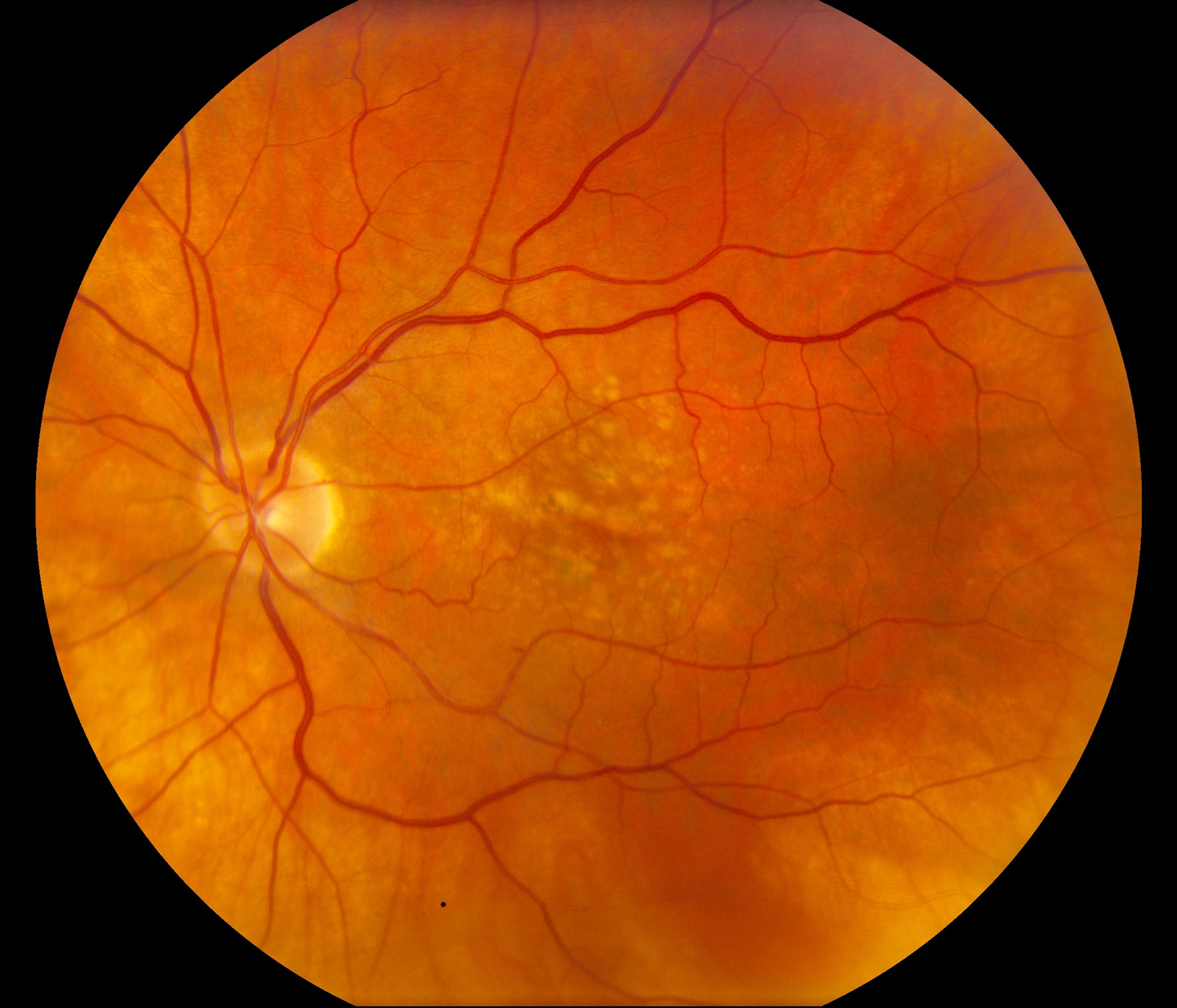 Retina photograph showing macular degeneration transitioning to the advanced stage