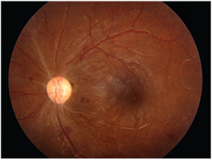 Retina photograph of an eye affected by uveitis